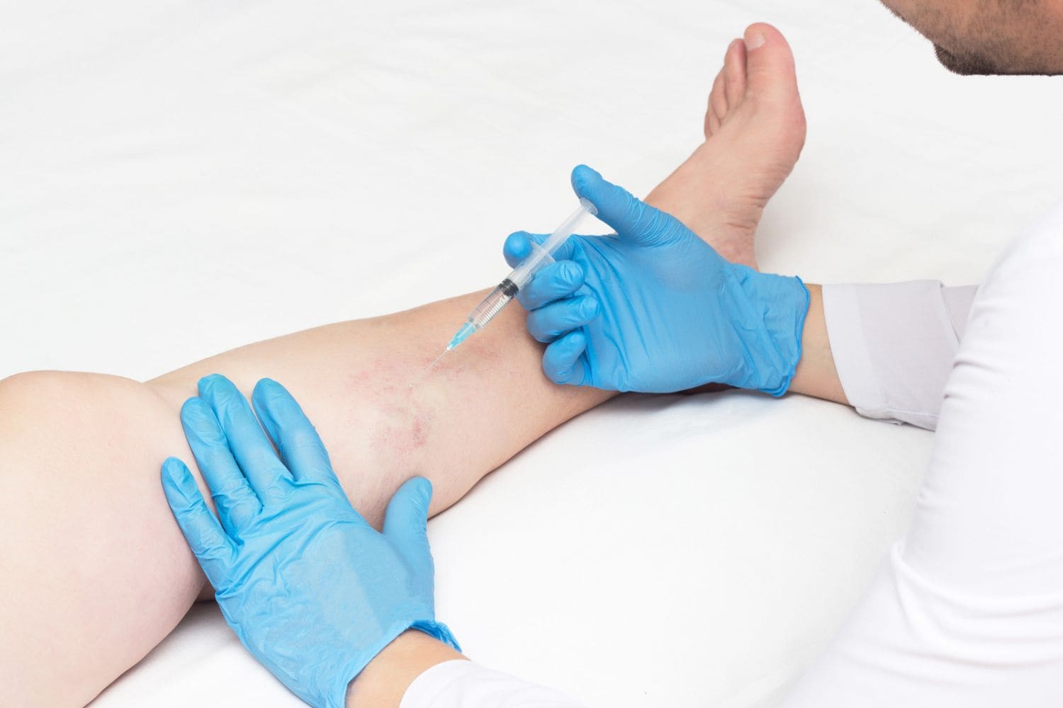 opération des varices opération des varices avec injection