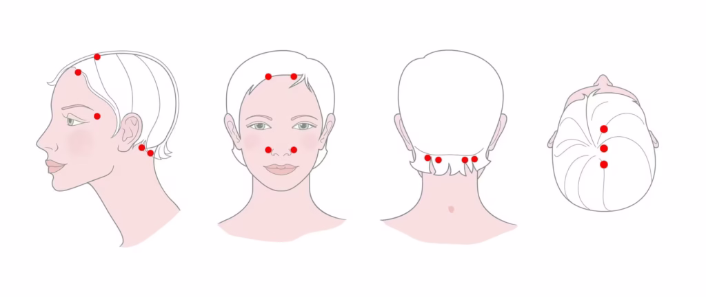 Schéma des points d'acupression pour soulager une migraine